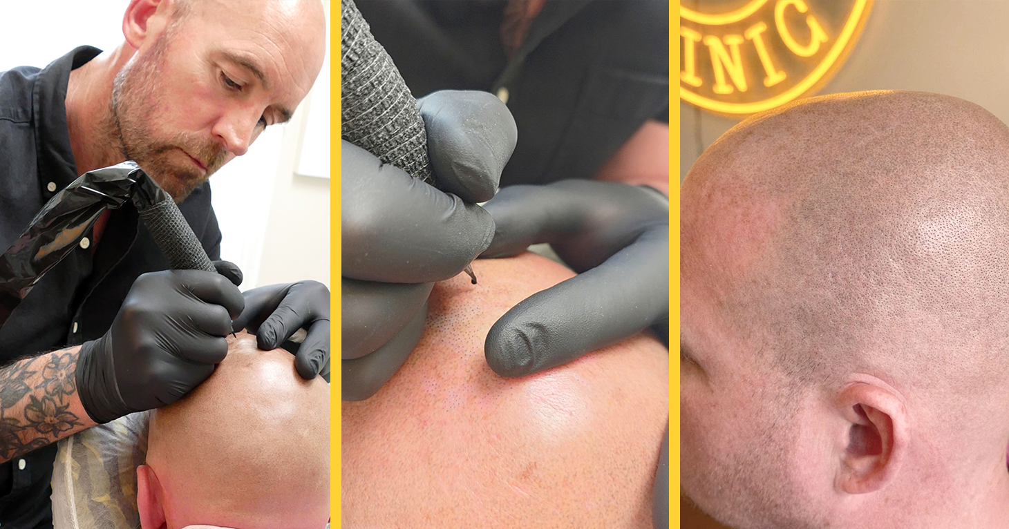 'When it's done well, it looks completely natural' – how SMP helps people with hair loss get their confidence back